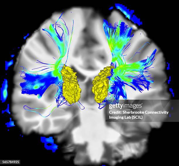 coronal view of a human brain in parkinsons disease. yellow surface is the caudate and blue/green areas highlight fibers of the motor system - neuroanatomy stock pictures, royalty-free photos & images