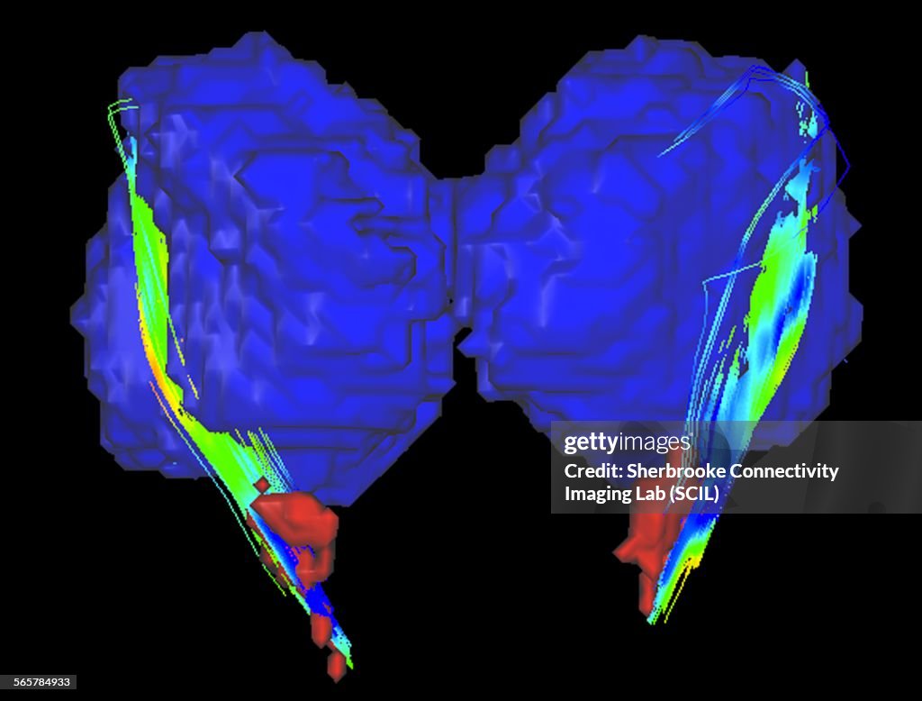 Connections between the substancia nigra and the thalamus in a Parkinsons brain