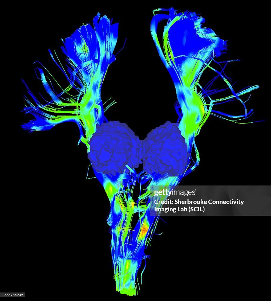 Cortical spinal tract, major bundle in the motor system, and thalamus in blue surface, in a Parkinsons brain