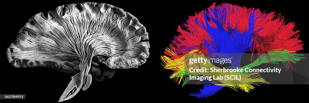 Sagittal, side view. Left - picture of a human brain dissection by a neuroanatomist, Right - reconstructed fibers by tractography
