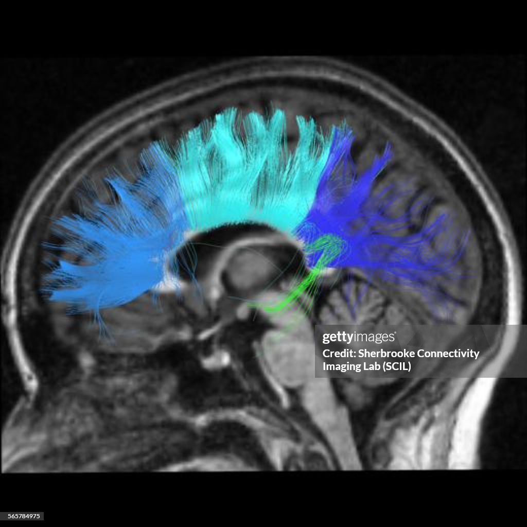 Side view of the corpus callosum fibers. The largest structure connecting left and right hemisphere