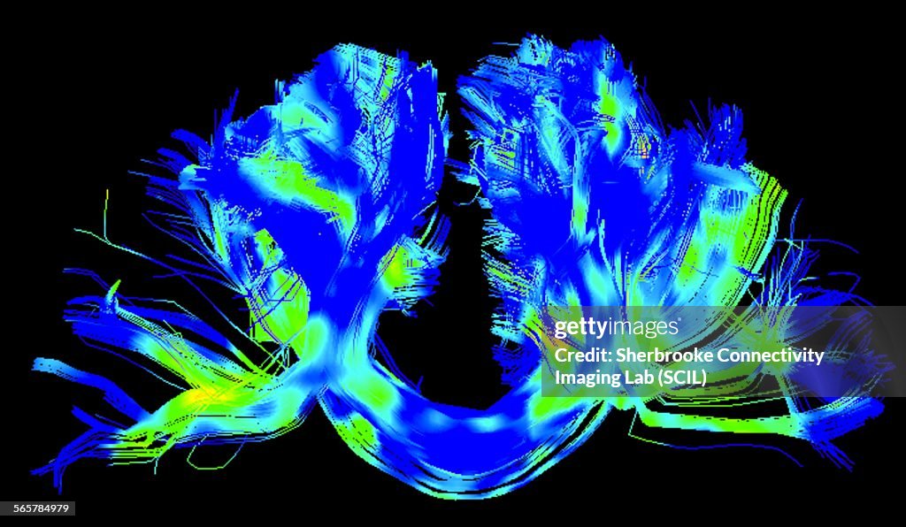 Corpus callosum, left-right connections, in a Parkinsons brain