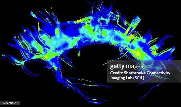 the cingulum bundle in a parkinsons brain - neuroanatomy stock pictures, royalty-free photos & images