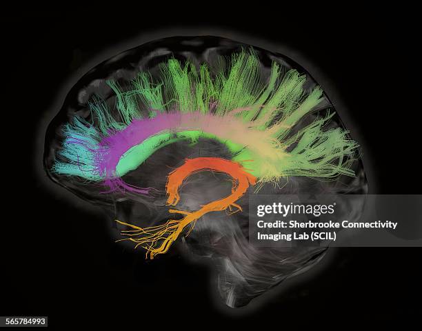 the fiber tracts involved in aging. the splenium and genu of the corpus callosum, the fornix and the cingulum bundle. human subject - corps calleux photos et images de collection