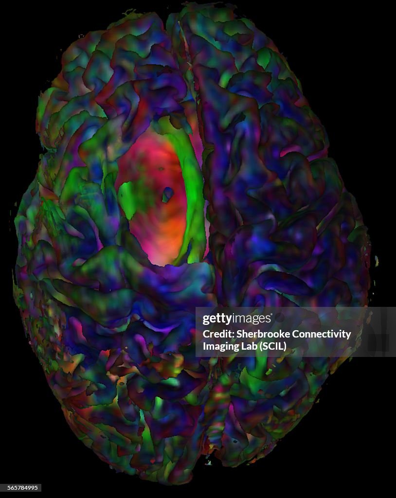 Top view of a cortical mesh, colored with diffusion orientation in Red-Green-Blue (Left-Right, Front-Back, Inferior-Superior) and the tumor cavity showing a hole