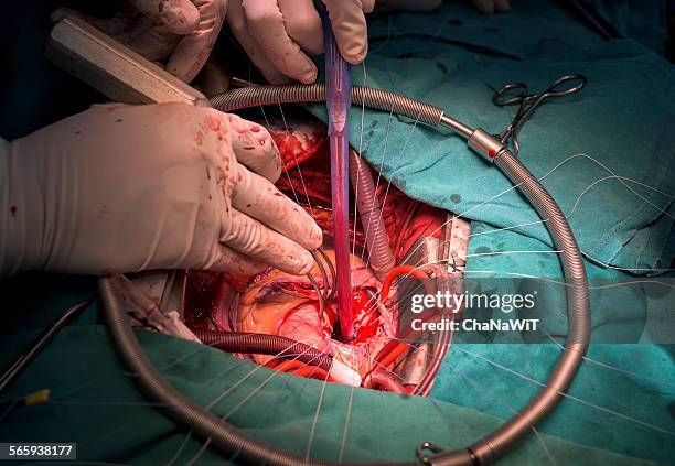 mitral valve repair - open heart surgery stock pictures, royalty-free photos & images