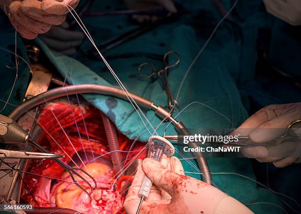 heart surgeon suture artificial heart valve - anatomical valve stock pictures, royalty-free photos & images