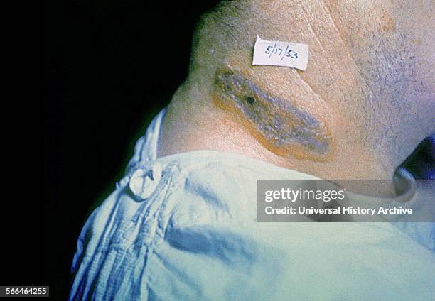 Anthrax skin lesion on neck of man.