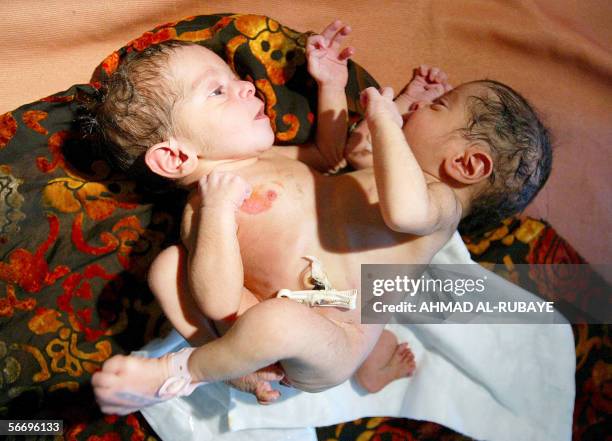 Newborn conjoined twins lie at a paediatric ward at Fatima al-Zahraa Teaching Hospital in the Shiite neighborhood of Baghdad's Sadr City 27 January...