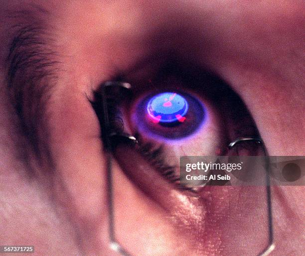 Eye.#7.AS.1897.A UCLA, Los Angeles, CA. Dr. Robert K. Maloney, M.D., M.A., Director of Diseases and Surgery of the Cornea at the UCLA Laser...