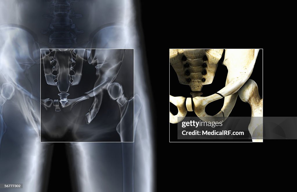 Anterior view showing fractures in the pelvis.