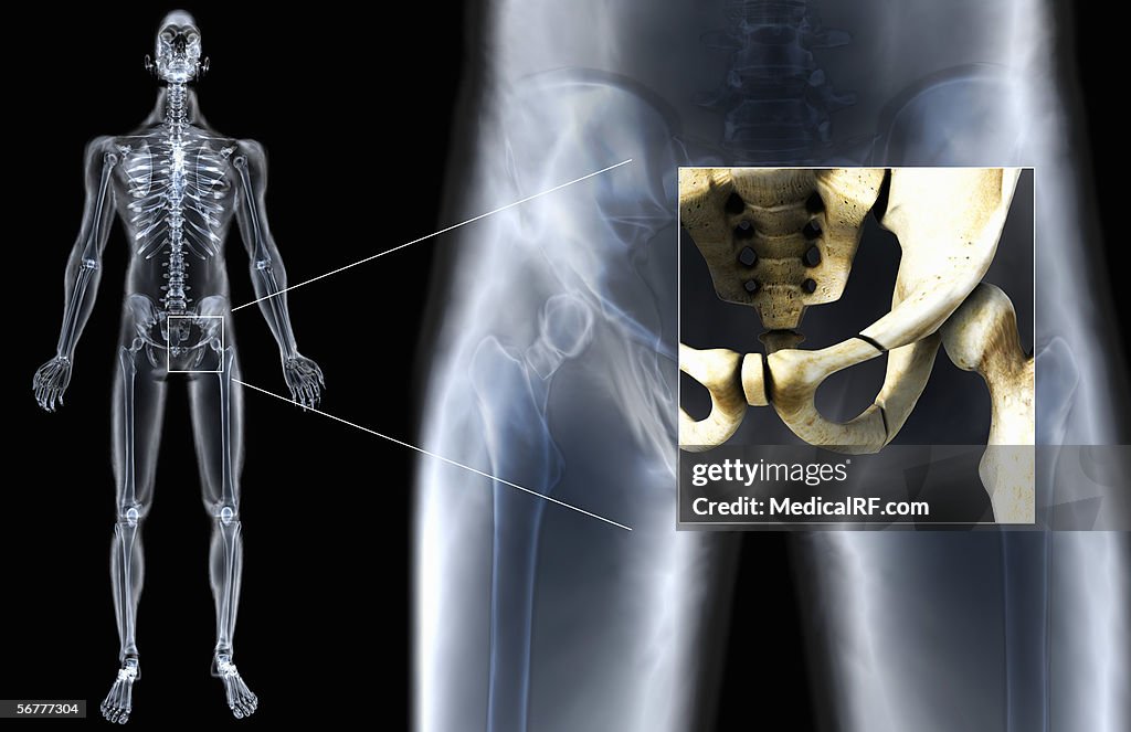 Anterior view showing fractures in the pelvis.