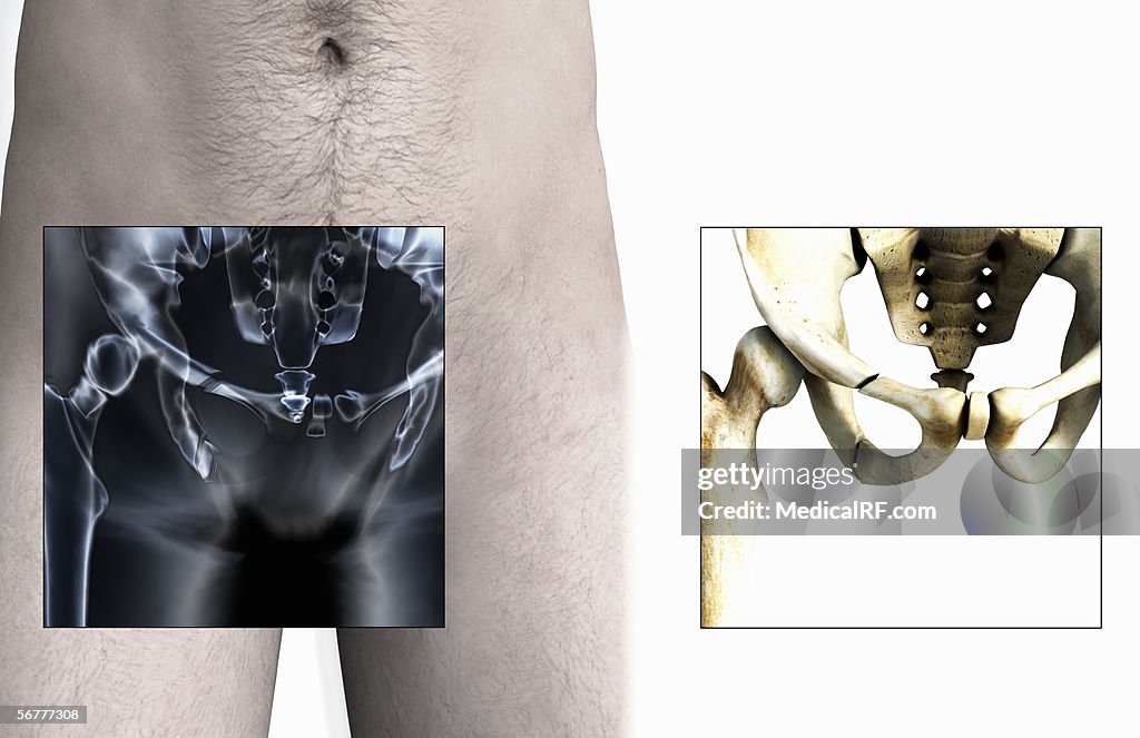 Anterior view showing fractures in the pelvis.