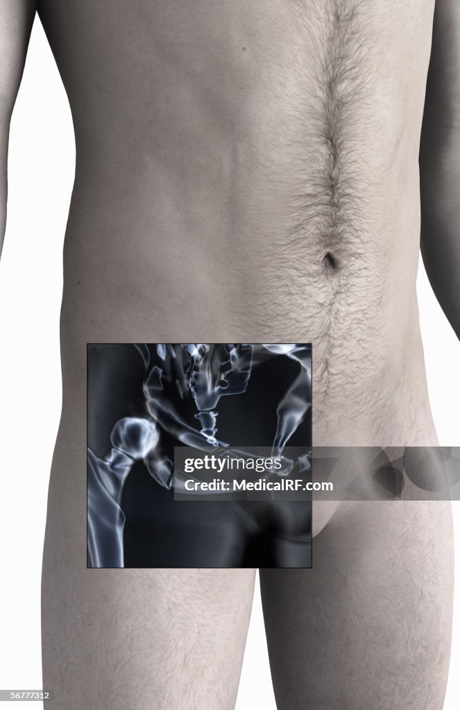 Anterior angled view showing fractures in the pelvis.