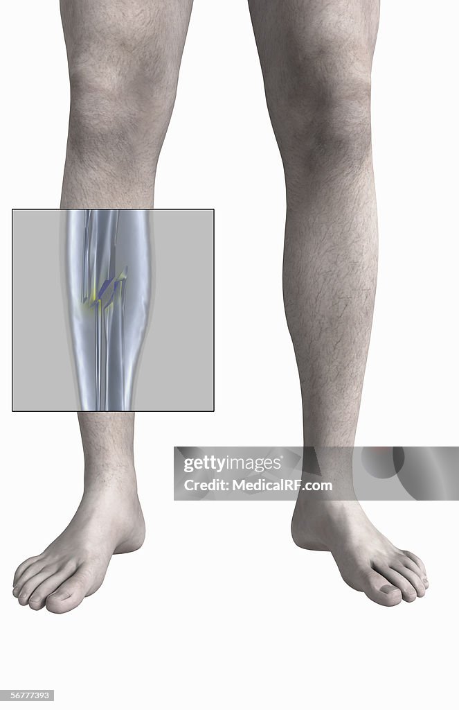 Anterior View Showing Fractures Of The Right Fibula And Tibia ...