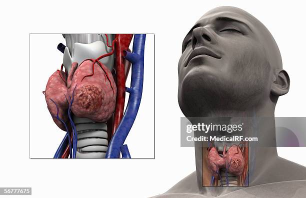 illustrazioni stock, clip art, cartoni animati e icone di tendenza di thyroid cancer. - tiroide