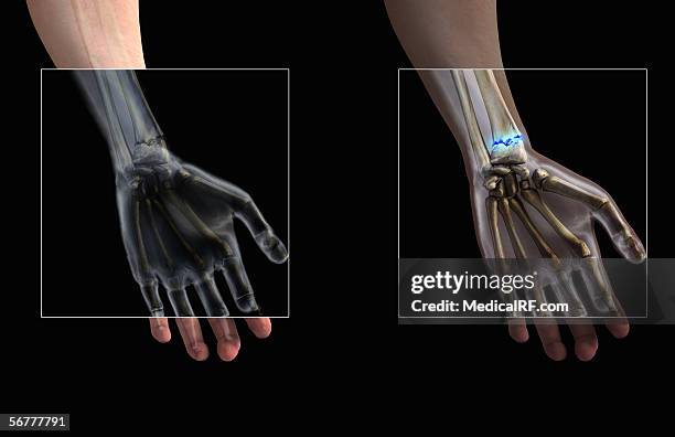 illustrations, cliparts, dessins animés et icônes de anterior close-up view showing a fracture of the radius in the left wrist. - split screen