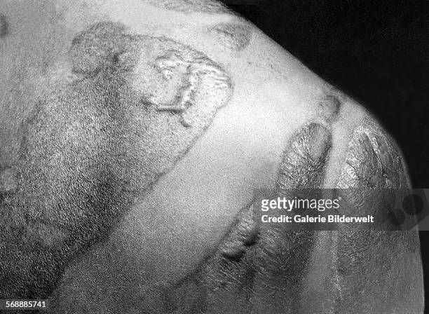 Formation of keloidal scars on the back and shoulder of a victim of the Hiroshima blast. September, 1945. The scars have formed where the victim's...