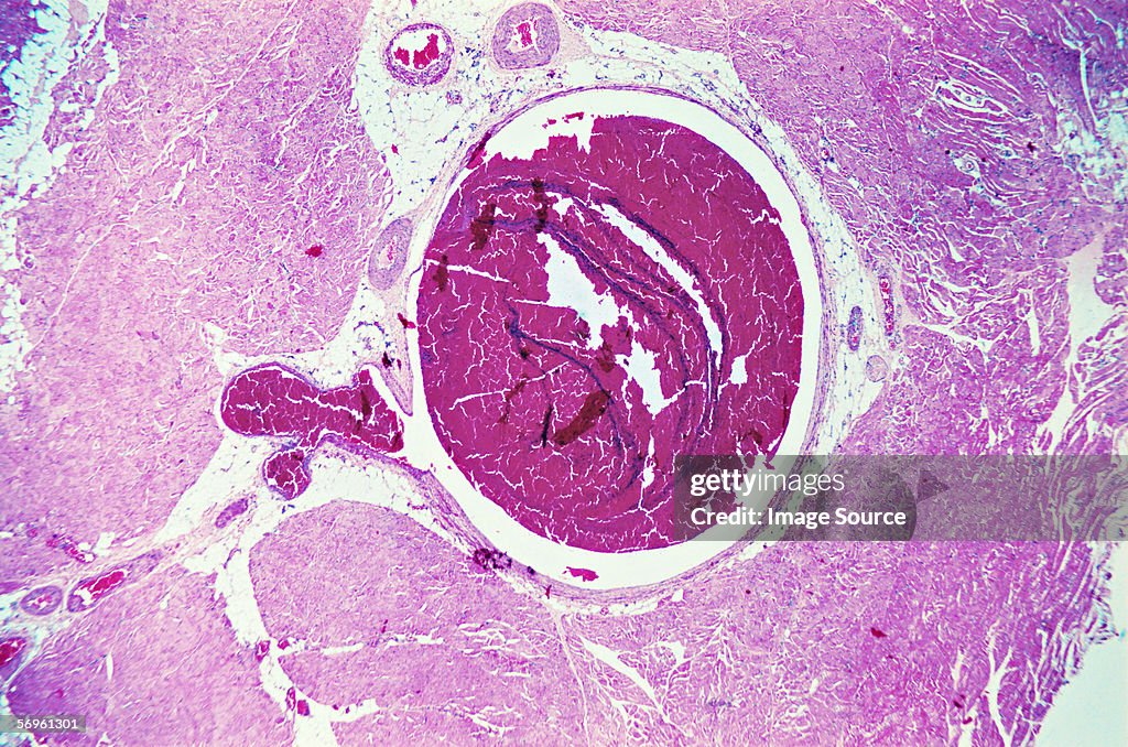 Thrombosis in leg vein