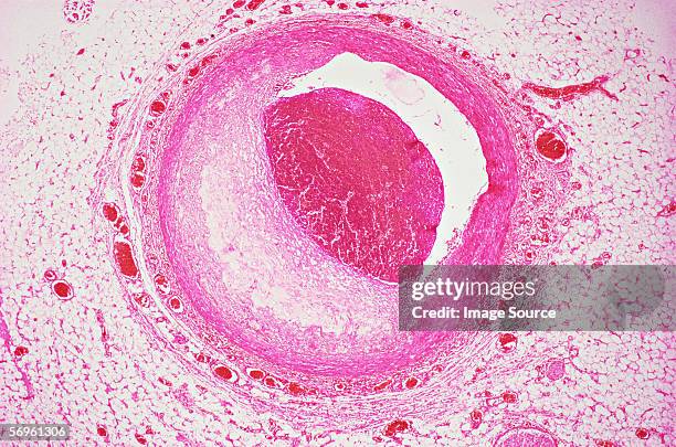 coronary artery - atheromatose stockfoto's en -beelden