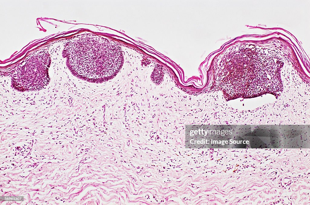 Basal cell carcinoma