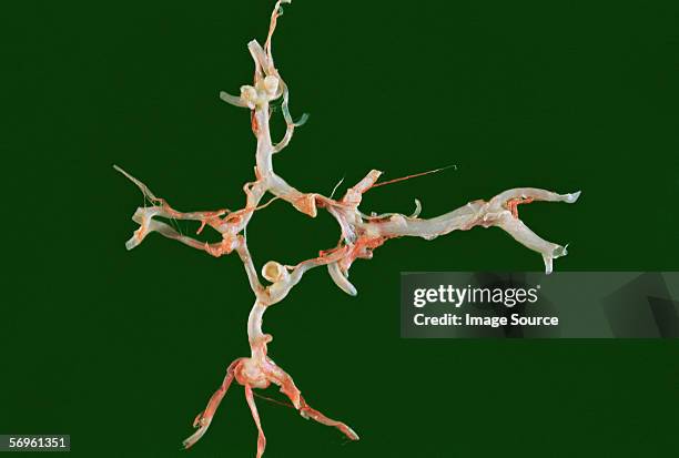 berry aneurysm - aneurysm stock pictures, royalty-free photos & images