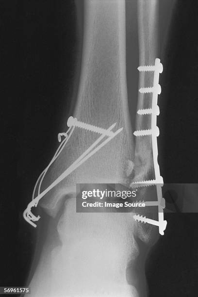 Snapped Tibia 40 Tibia Fracture Recovery Stock Photos, High-Res Pictures, and Images ...