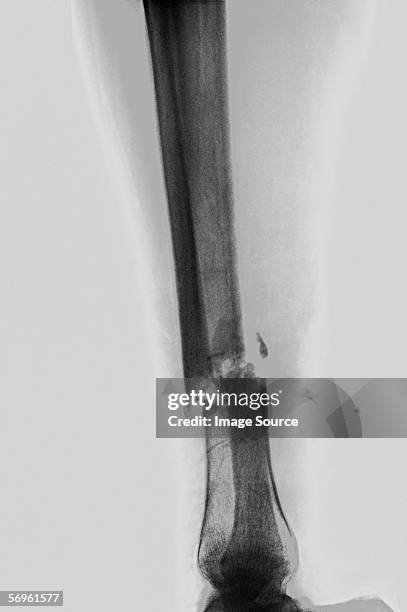 317 Tibia Fibula X Ray Stock Photos, High-Res Pictures, and Images ...