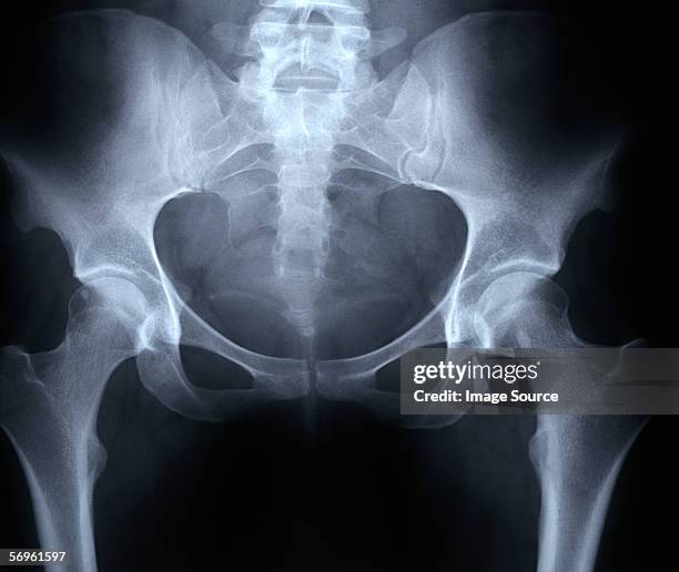 x-ray of female pelvis - x ray pelvis stock pictures, royalty-free photos & images