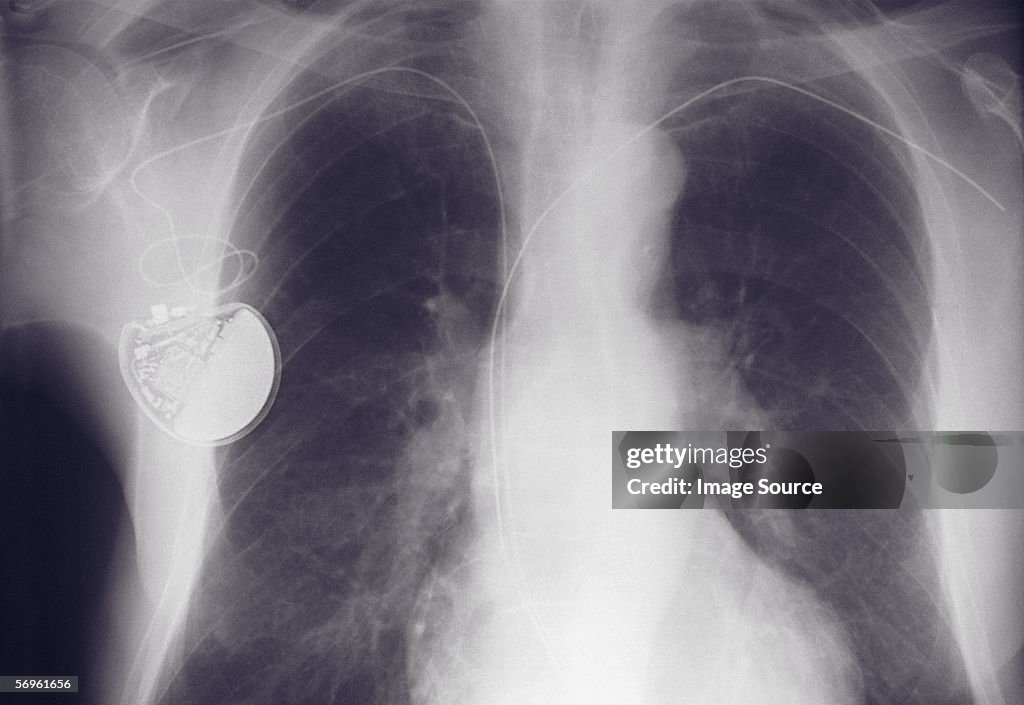 Pacemaker Radiology Xray Of Chest Showing Pacemaker High-Res Stock Photo - Getty Images