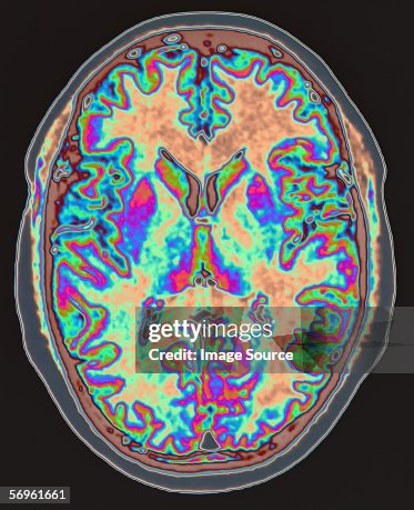 MRI scan of brain MRI scan of brain