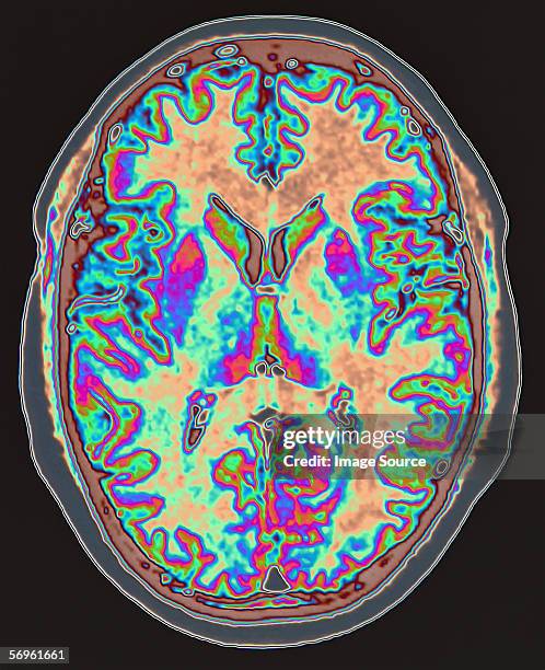exame de ressonância magnética do cérebro - tomografia imagens e fotografias de stock