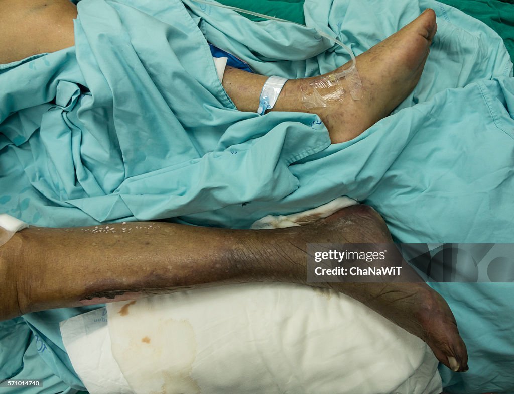 Wet gangrene right foot