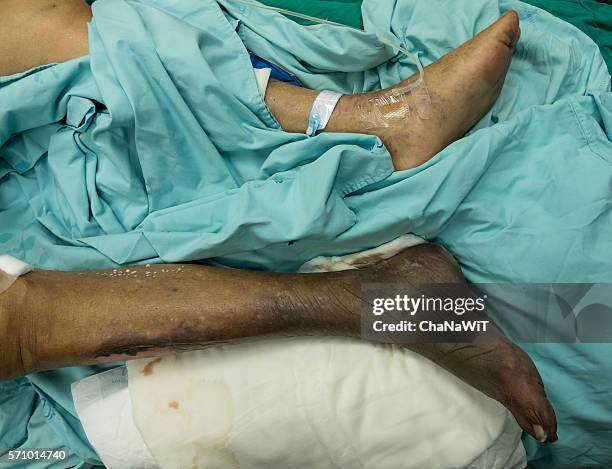 wet gangrene right foot - wet gangrene stock pictures, royalty-free photos & images