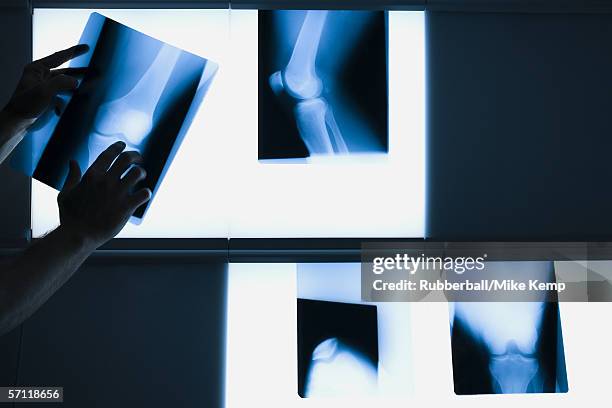 person's hand positioning an x-ray - right knee anatomy stock pictures, royalty-free photos & images