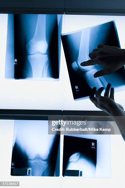 person's hand pointing to an x-ray - right knee anatomy stock pictures, royalty-free photos & images