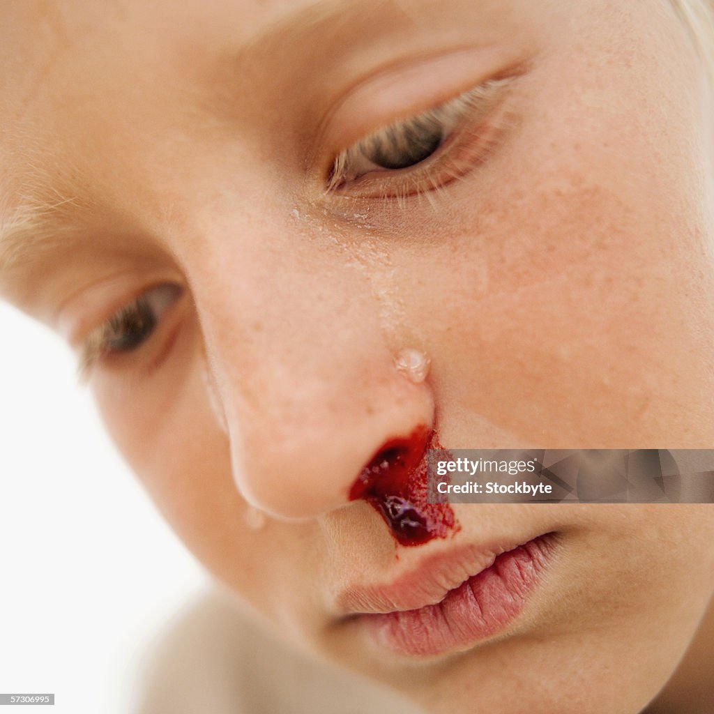 Close-up of a boy (10-12) crying with a bleeding nose