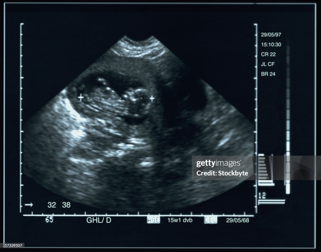Ultrasound image of a human fetus