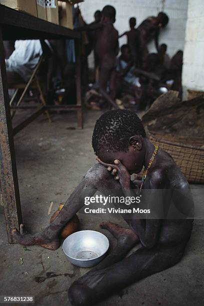 Severely malnourished child covers his face in grief at a feeding center in Kondor, Sudan. Civil war and widespread famine have ravaged Sudan for...