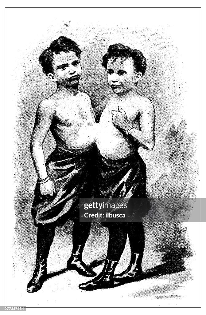 Antique illustration of Conjoined twins