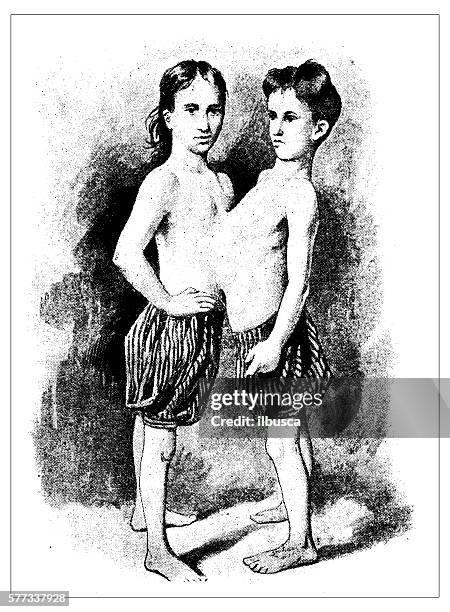 antique illustration of conjoined twins - conjoined twin stock illustrations