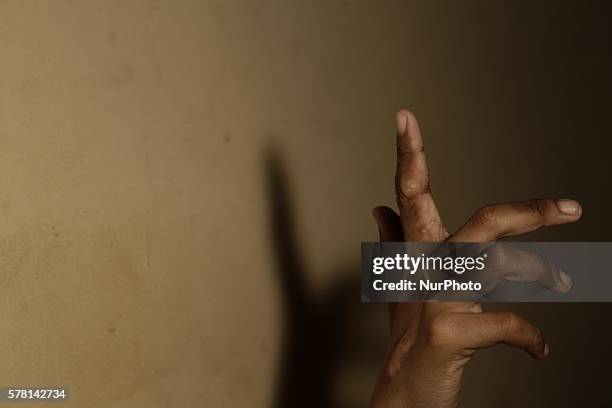 Jakarta, Indonesia, 20 July 2016 : REZA JIVAN DARMAWAN son of mother Mrs. SITI CHODIJAH diagnose with Lamfa Dimita TB and Kelloid Maligna rest at...