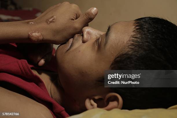 Jakarta, Indonesia, 20 July 2016 : REZA JIVAN DARMAWAN son of mother Mrs. SITI CHODIJAH diagnose with Lamfa Dimita TB and Kelloid Maligna rest at...