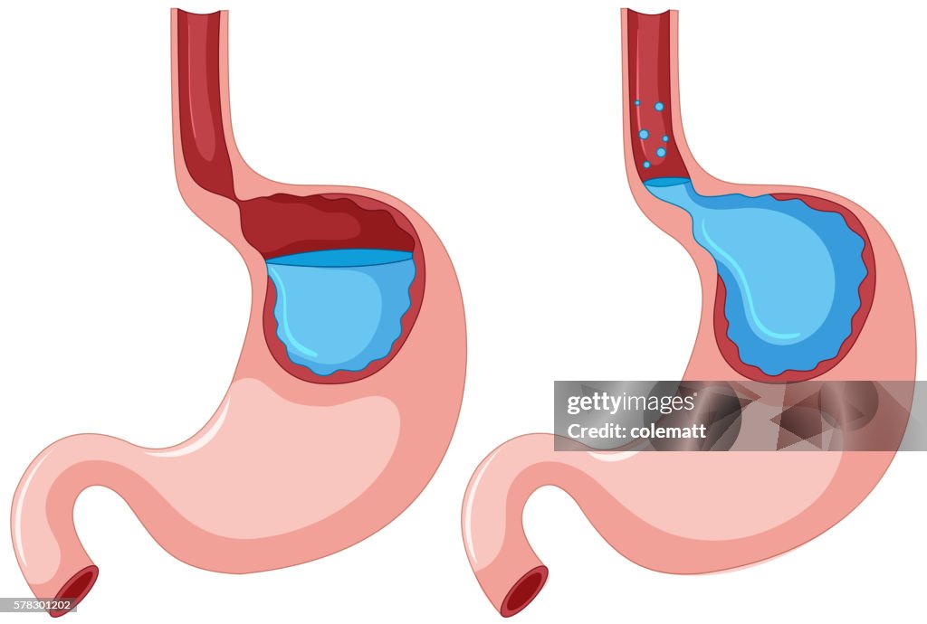 Reflü Diagram Of Gastroesophageal Reflux Disease High-Res Vector Graphic ...