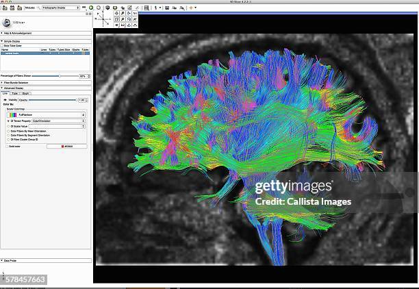 16 Diffusion Tensor Mri Stock Photos, High-Res Pictures, and Images ...