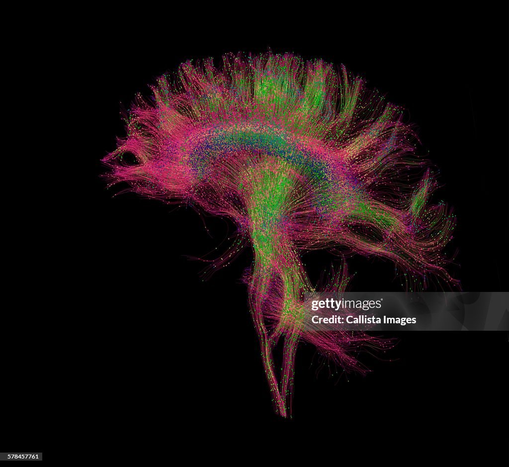 Diffusion Mri Also Referred To As Diffusion Tensor Imaging Or Dti Of ...