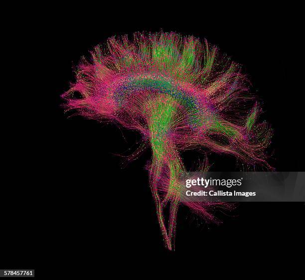 diffusion mri, also referred to as diffusion tensor imaging or dti, of the human brain - medical scan 個照片及圖片檔