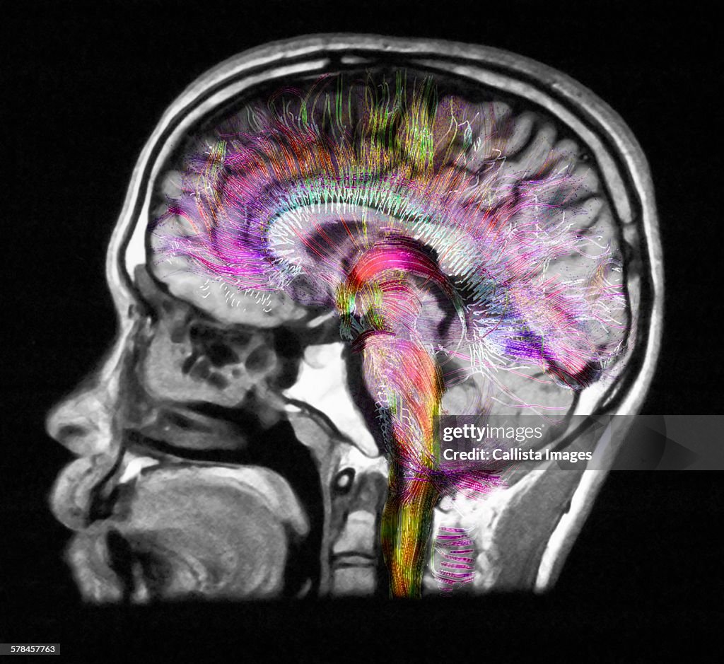 Diffusion MRI, also referred to as diffusion tensor imaging or DTI, of the human brain
