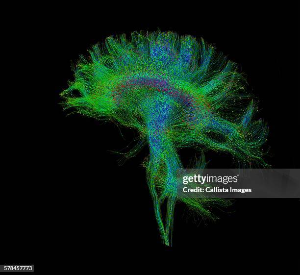 16 Diffusion Tensor Mri Stock Photos, High-Res Pictures, and Images ...
