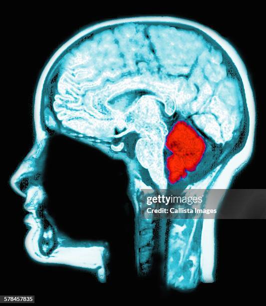 mri scan of the brain, computer enhanced to highlight the cerebellum (red) - cerebelo - fotografias e filmes do acervo
